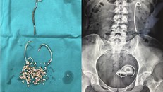 3 đoạn stent được lấy ra kèm theo nhiều sỏi bàng quang