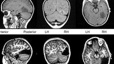Tanner bị cắt bỏ 1/6 não bộ để ngăn ngừa chứng động kinh. (Ảnh: Dailymail).