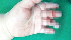 Bàn tay bé T.A bị máy xay nghiền nát 