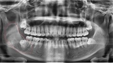 Thanh niên Hà Nội tưởng mọc răng khôn, bác sĩ lôi ra ‘thủ phạm’ trong miệng