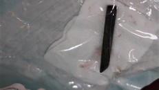 Đầu đữa dài 9cm nằm 4 năm trong hốc mắt bệnh nhân