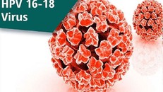 Nhiễm Human Papilloma virus (HPV) là 1 trong 4 STD không thể chữa khỏi.