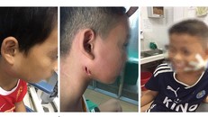 Ba bệnh nhân nhiễm "vi khuẩn ăn thịt người" được điều trị tại Bệnh viện Sản nhi Nghệ An.