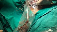 Búi giun lấy ra từ bụng bệnh nhi. Ảnh: Infonet. 