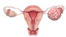 Căn bệnh ung thư di truyền khiến 3 chị em gái ở Hà Nội cùng mắc