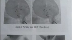 Túi độn ngực vỡ của nữ bệnh nhân được các sĩ lấy ra