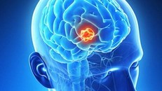 Virus corona chủng mới có thể gây u não?