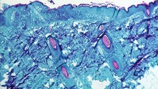 WHO cảnh báo nguy cơ bệnh đậu mùa khỉ lây lan mạnh vào mùa Hè