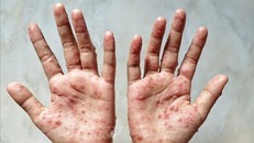 Bến Tre phát hiện ca bệnh đậu mùa khỉ đầu tiên