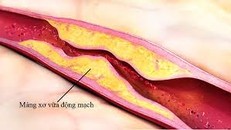 Phát hiện các đặc điểm giống ung thư trong chứng xơ vữa động mạch