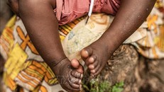 WHO tiếp tục cảnh báo nguy cơ từ bệnh đậu mùa khỉ tại châu Phi