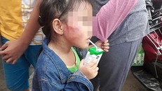 Bé D bị cô giáo đánh bầm tím trên má. (Ảnh: Ngọc Như)