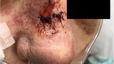 Người phụ nữ tử vong sau khi dùng nước rửa mũi chữa viêm xoang