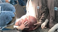 Các bác sỹ phẫu thuật bóc tách khối u buồng trứng khổng lồ. (Ảnh: TTXVN phát)