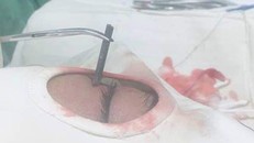 Các BS lấy chiếc đinh ra khỏi hốc mắt bệnh nhân H.