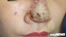 ‘Nát mặt’ vì tiêm chất tan mỡ tạo cằm V-line đón Tết