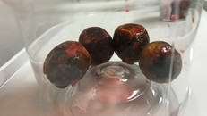 4 viên sỏi kích thước lớn được lấy từ túi mật của bệnh nhân. Ảnh: BVCC