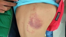 Cháu bé lớp 2 bị cô giáo đánh bầm lừng vì làm sai bài tập.