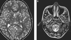 Kết quả chụp MRI cho thấy chàng trai có nhiều nang sán trong vỏ não (hình bên trái là các chấm trắng). Các tổn thương cũng được tìm thấy trong thân não và tiểu não của anh ta (nhìn bên phải).