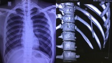 Hình ảnh chiếc đinh trong khoang phổi nam bệnh nhân. (Ảnh: BVCC)