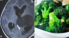 Bệnh nhi 10 tuổi suýt mất mạng vì chữa bệnh u não bằng phương pháp ‘keto’