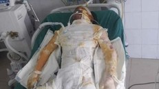 Sập lò tại công ty gang thép, 3 công nhân bỏng nặng