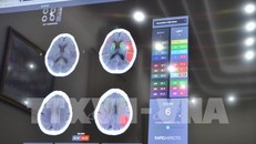 Bệnh viện Việt ứng dụng trí tuệ nhân tạo trong điều trị đột quỵ