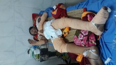 Cháu Vũ bị bỏng nặng 70% cơ thể do bị điện giật.