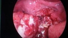 Nuốt phải xương gà trong buổi liên hoan, một trẻ 12 tuổi bị thủng ruột