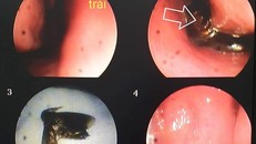 Hình ảnh con bướm bay vào mũi bệnh nhân.