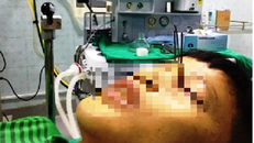 Bệnh nhi bị ghim sắt ghim vào hốc mắt.