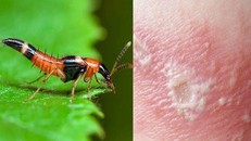 Nọc độc kiến ba khoang gây tổn thương nặng ở vùng da.