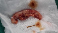 Hình ảnh đoạn ruột thừa và chiếc tăm xỉa răng của bệnh nhân. Ảnh: Zing.vn