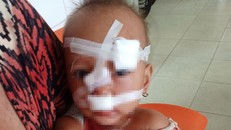 Bố mẹ cãi nhau, bé gái 2 tuổi phải khâu 12 mũi trên mặt