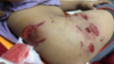 Phú Thọ: Bé trai 7 tuổi bị chó lai nặng 30 kg cắn nát chân