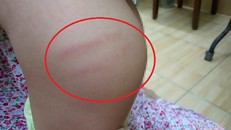 Hình ảnh 2 vết bầm tím phụ huynh chụp lại. - Ảnh: Vietnamnet