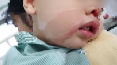 Bé trai bị bỏng nặng do mẹ nhỏ nhầm axit vào mũi. 