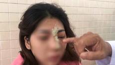 Cô gái mù một mắt sau khi tiêm filler ở 1 spa tại nhà. - Ảnh: Vietnamnet