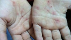 Bàn tay cháu bé bị nhiều vết thương do vật nhọn đâm vào.