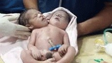 Siêu âm sinh đôi, sản phụ hốt hoảng khi đẻ ra bé trai 2 đầu 3 tay
