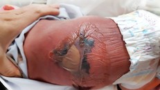 Một trẻ sơ sinh bị bỏng nặng, nhiễm trùng máu do sưởi ấm bằng than