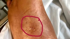 Cứu sống bệnh nhân suýt chết vì giẫm phải vật nhọn