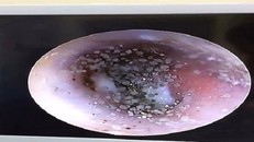 Mọc nấm ở tai vì đeo headphone quá nhiều