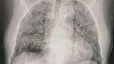 Hình ảnh phổi người mắc Covid-19 ở Việt Nam