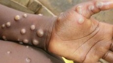 Tăng cường giám sát, phát hiện ca nghi ngờ bệnh đậu mùa khỉ