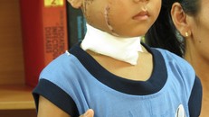 Bé 6 tuổi bị cánh quạt công nghiệp chém thấu xương