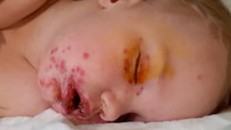 Bé trai nhiễm khuẩn herpes do 'nụ hôn tử thần'