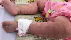 Một ca mắc bệnh sởi. Ảnh minh họa: Đinh Hằng/TTXVN