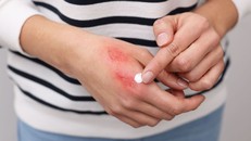 Phát triển da nhân tạo sinh học giúp điều trị bỏng nặng