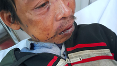 Ông Phạm Văn Hậu, người Chơ-ro bị hành hung thương tích đầy thân thể vào tối ngày 22/1, sau đó có dấu hiệu rối loạn tâm thần phải chuyển viện điều trị. Ảnh: Xuân Thời.